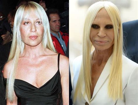 donatella versace before and after surgeries|versace lady plastic surgery.